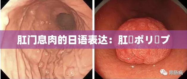 肛门息肉的日语表达：肛門ポリープ