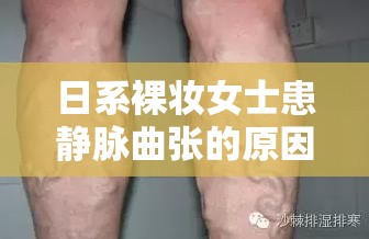 日系裸妆女士患静脉曲张的原因探究